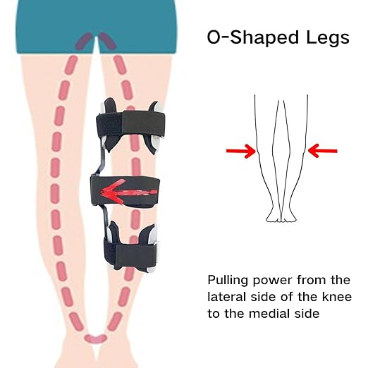 Kids O/X Legs Type Correction Brace, Pediatric Leg Posture Corrector, Children Legs Straightener for Knees Valgus Deformity Bow Legs, Leg Knee Orthosis Brace