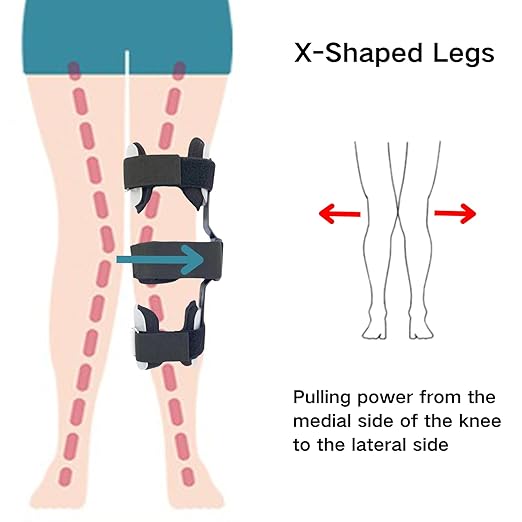 Kids O/X Legs Type Correction Brace, Pediatric Leg Posture Corrector, Children Legs Straightener for Knees Valgus Deformity Bow Legs, Leg Knee Orthosis Brace