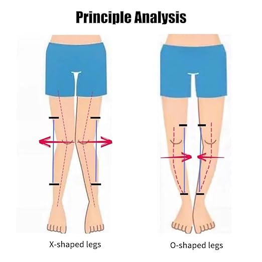 Kids O/X Legs Type Correction Brace, Pediatric Leg Posture Corrector, Children Legs Straightener for Knees Valgus Deformity Bow Legs, Leg Knee Orthosis Brace