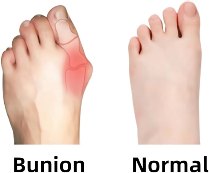 IEADEN Precut Kinesiology Tape for Bunion, 40 Pcs, Bunion Corrector & Relief, Big Toe Support and Pain Relief, Breathable Hypoallergenic Latex-Free Tape (Black)