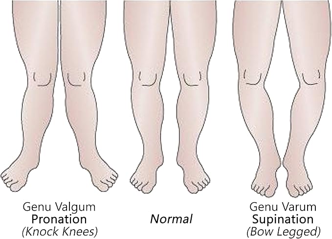 LAMINET Posture Corrective Heel Cups - Large - Fits Women's Shoe Size 8.5-11 / Fits Men's Shoe Size 7-13